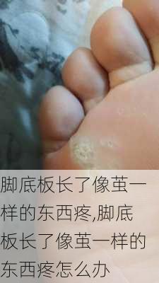 脚底板长了像茧一样的东西疼,脚底板长了像茧一样的东西疼怎么办